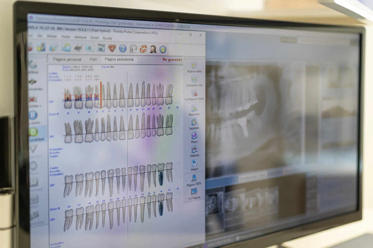 Tratamientos de implantes