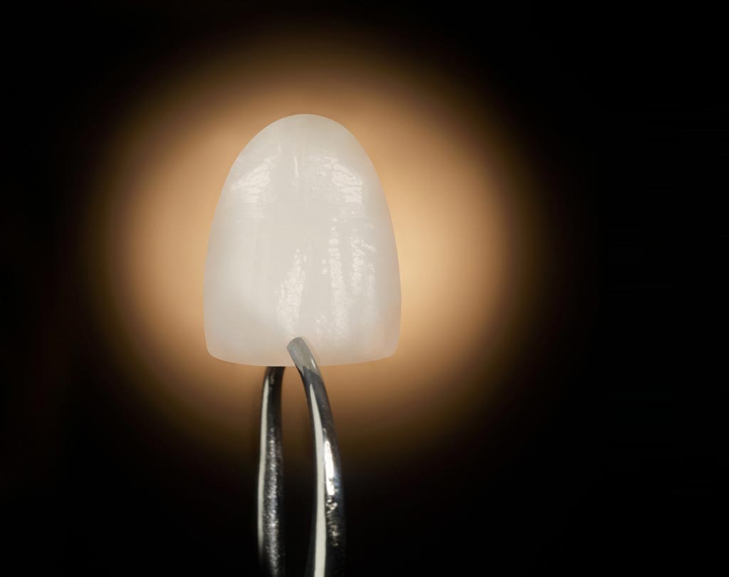 Carillas de composite