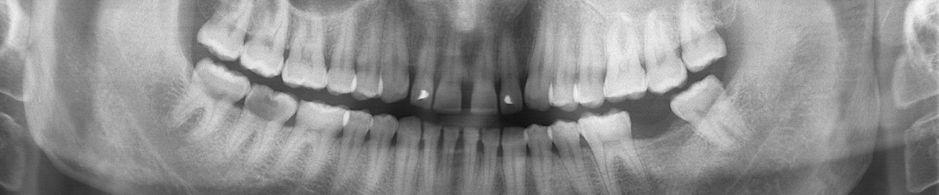 Causas y síntomas del bruxismo