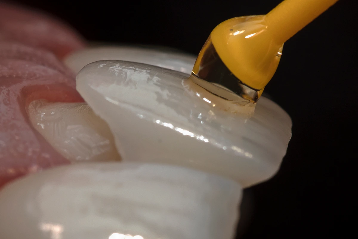 Colocación de carillas dentales