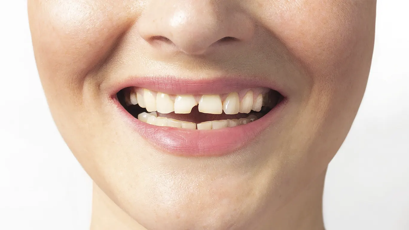 Fracturas de dientes