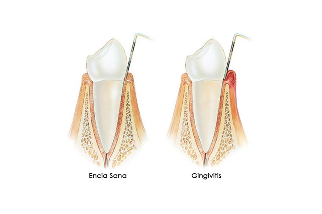 Gengivitis ilustración