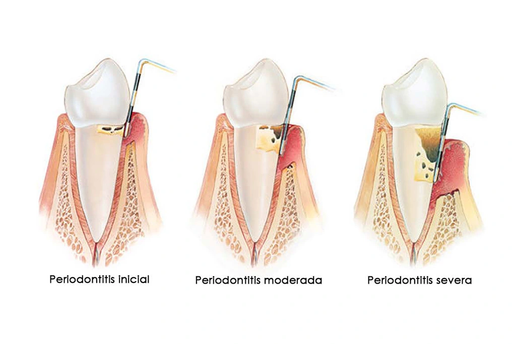 Periodontitis ilustración