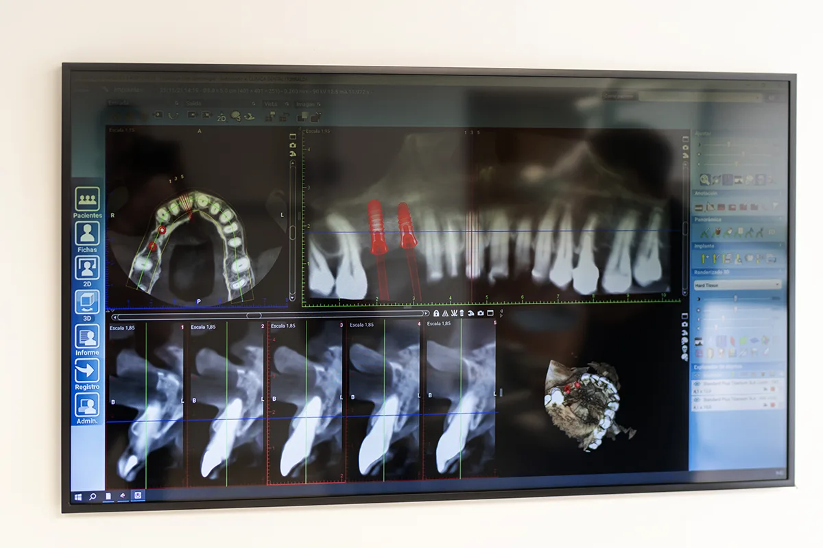 Tratamientos dentales con implantes