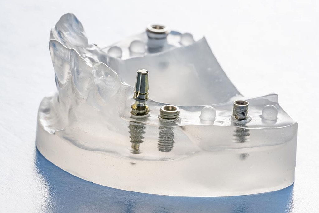 Tratamiento de implantes dentales