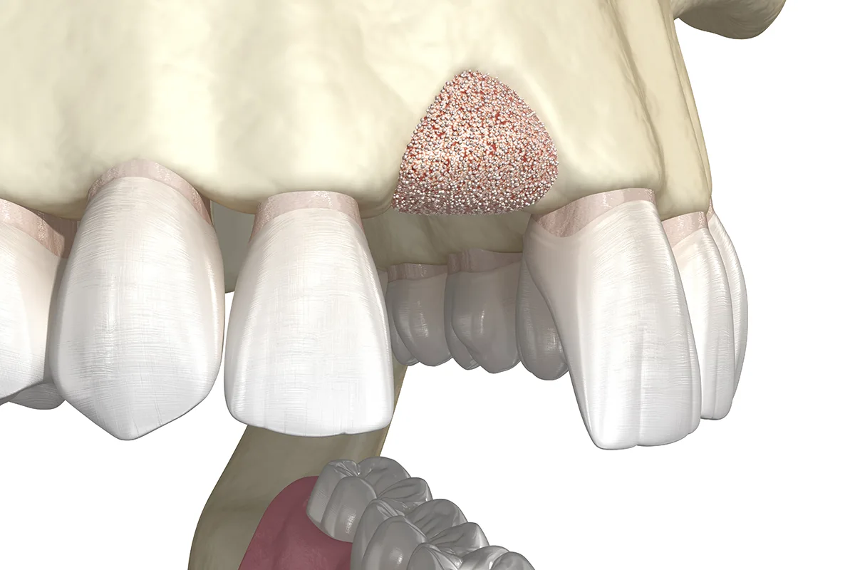 Regeneración periodontal