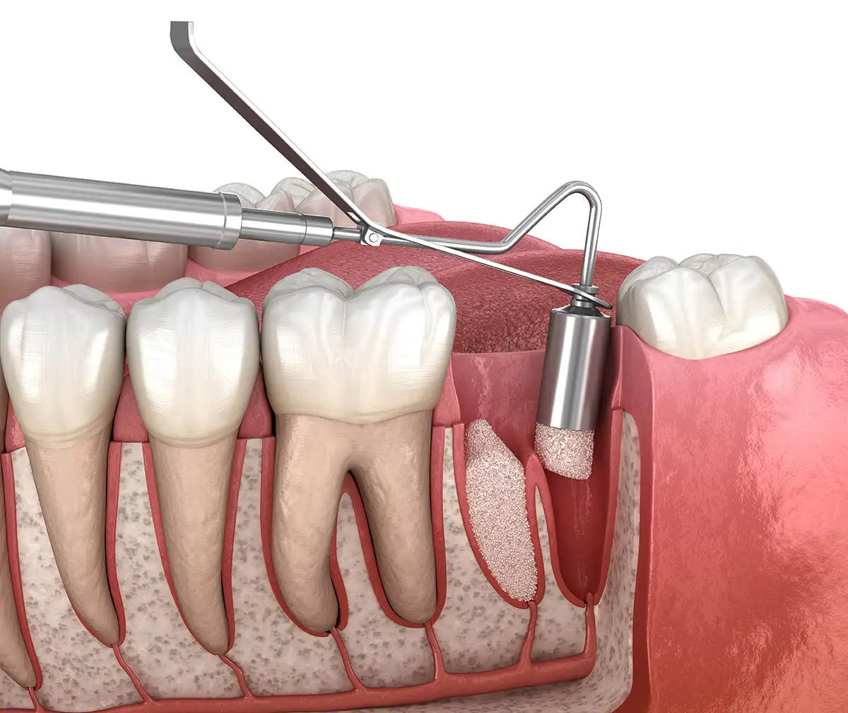 Regeneración ósea tras extracción